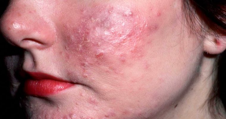 Acne rosacea: sintomi, rimedi e terapia