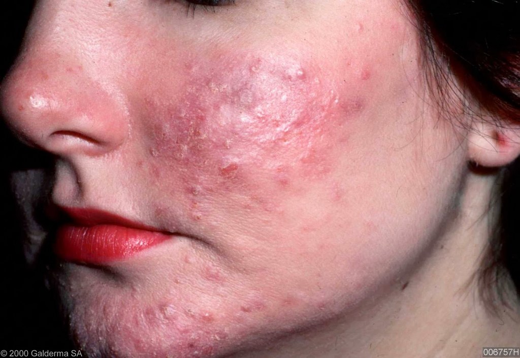 Acne rosacea: sintomi, rimedi e terapia
