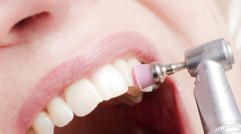 Pulizia dei denti dal dentista per una dentatura sana e robusta