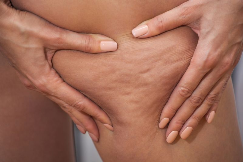 Le cause della cellulite