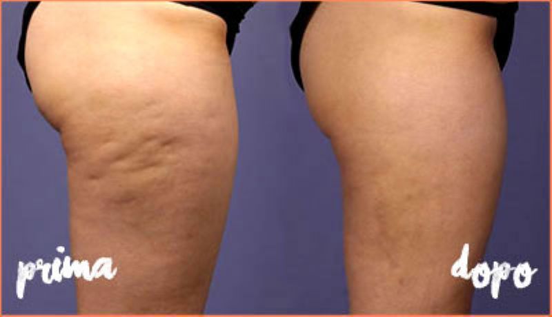 la-mia-cellulite-prima-dopo_800x460