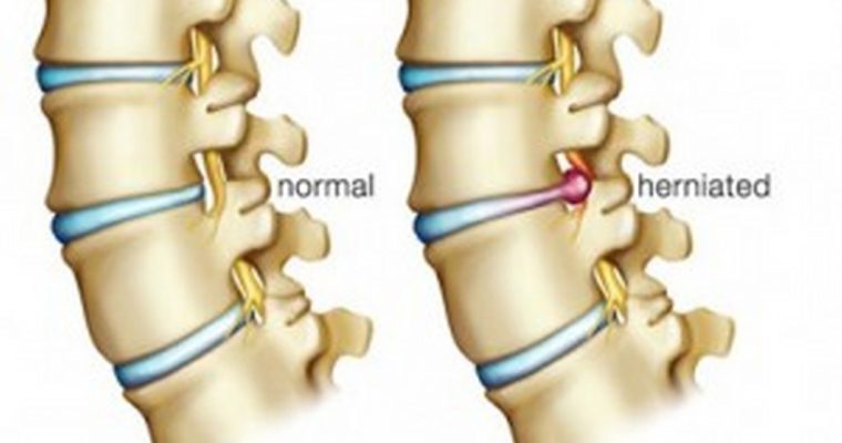 Ernia discale: tutti i sintomi per riconoscerla ed intervenire