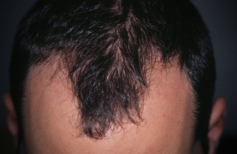 Alopecia areata: cause e rimedi da prendere in considerazione