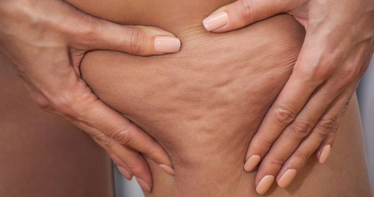 Le cause della cellulite