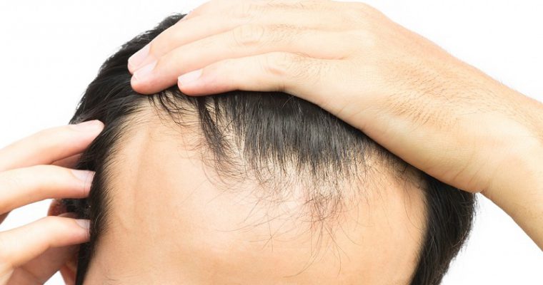 Perché cadono i capelli e quando preoccuparsi