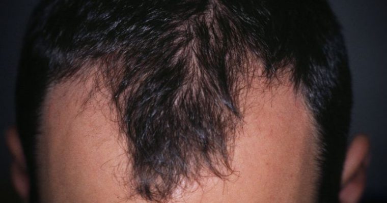 Alopecia areata: cause e rimedi da prendere in considerazione