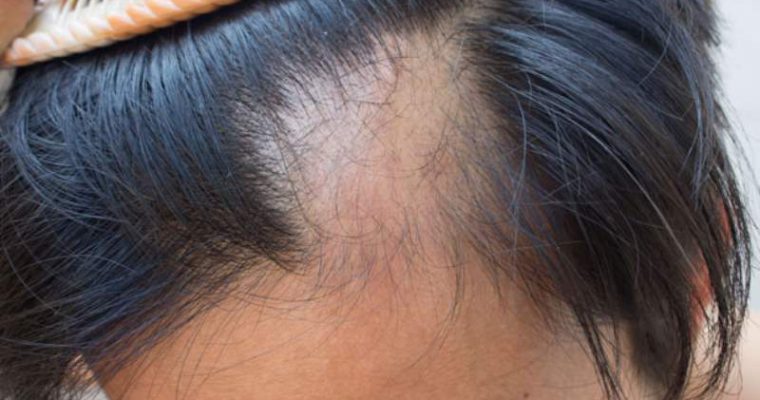 Alopecia e tiroide, tutto quello che si deve sapere