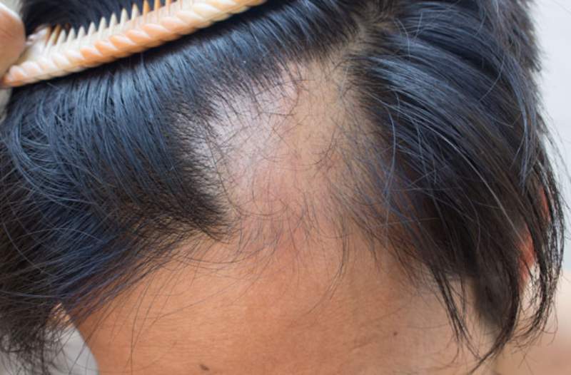 Alopecia e tiroide, tutto quello che si deve sapere